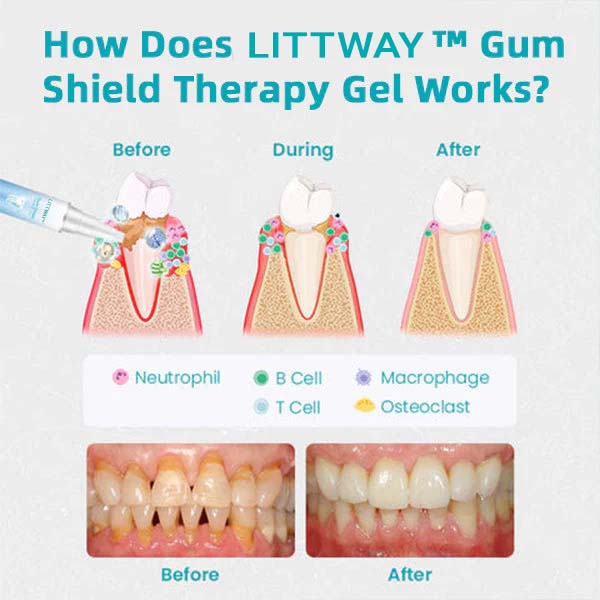 LITTWAY™ Gum Shield Therapy Gel