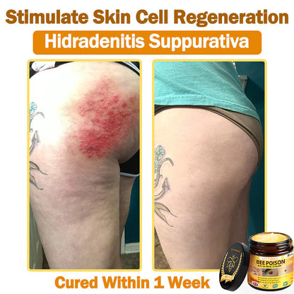 [Official Brand Store] 🐝 LOVILDS® Bee Venom All-In-One Cream (👩‍⚕️British Association of Dermatology 2025 Special Recommendation)