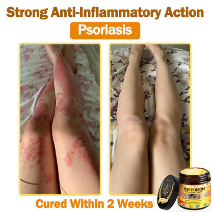 [Official Brand Store] 🐝 LOVILDS® Bee Venom All-In-One Cream (👩‍⚕️British Association of Dermatology 2025 Special Recommendation)