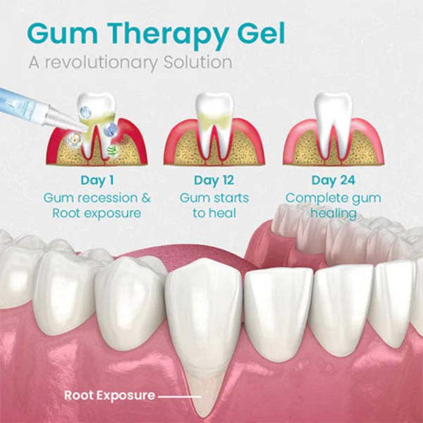 LITTWAY™ Gum Shield Therapy Gel