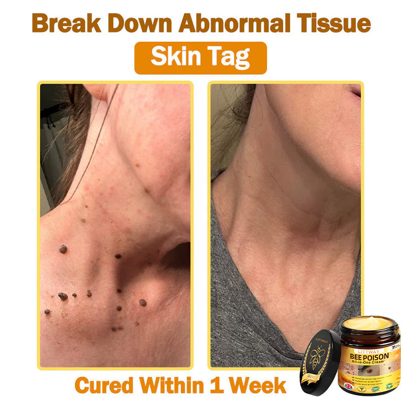 [Official Brand Store] 🐝 LOVILDS® Bee Venom All-In-One Cream (👩‍⚕️British Association of Dermatology 2025 Special Recommendation)