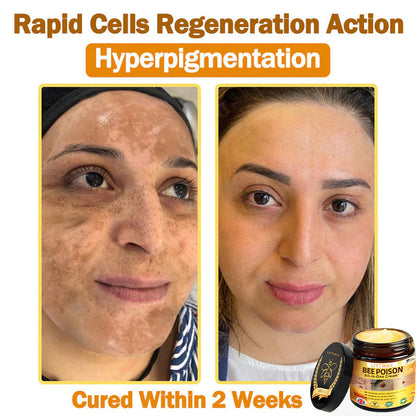 [Official Brand Store] 🐝 LOVILDS® Bee Venom All-In-One Cream (👩‍⚕️British Association of Dermatology 2025 Special Recommendation)