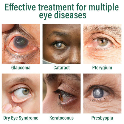 OptiFusion Nano Eye Drops Serum ✅FDA Approved(Suitable for presbyopia, dry eye syndrome, glaucoma, and cataracts) ☘️☘️